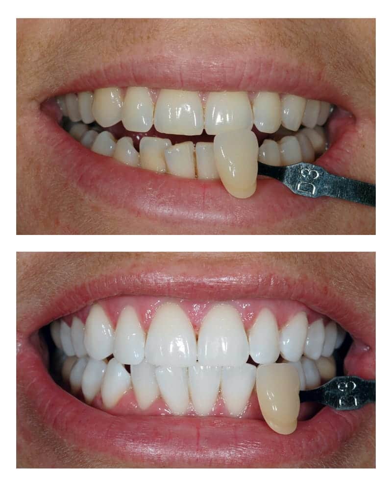before-after-teeth-whitening-leicester