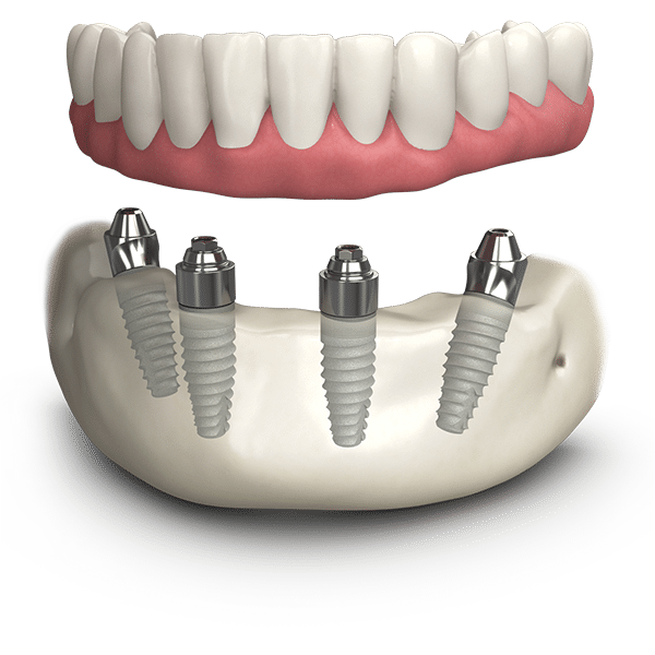 All-On-4 Dental Implants