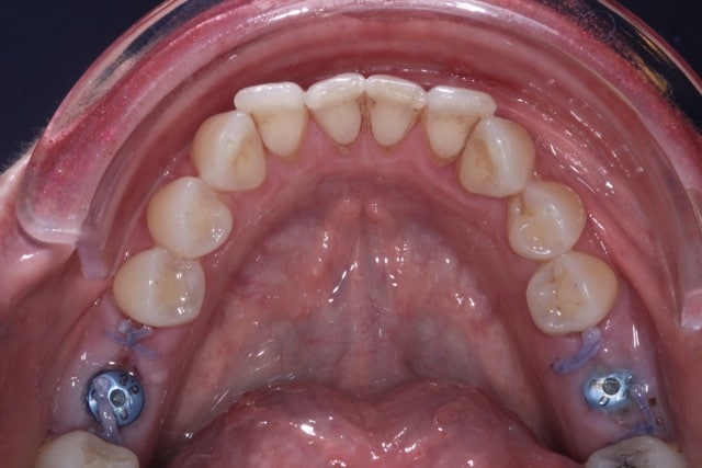 Before & After Dental Implants