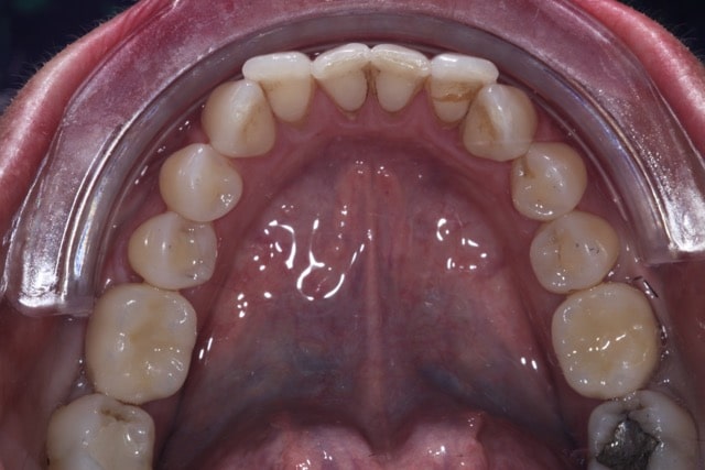 Before & After Dental Implants