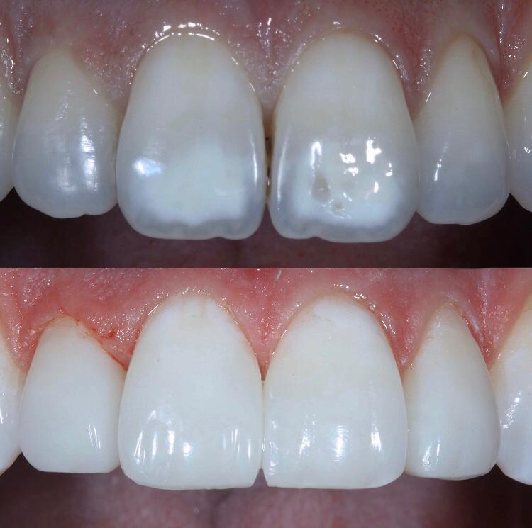 Teeth Bonding Leicester Contouring Leicester Quick Teeth Repair