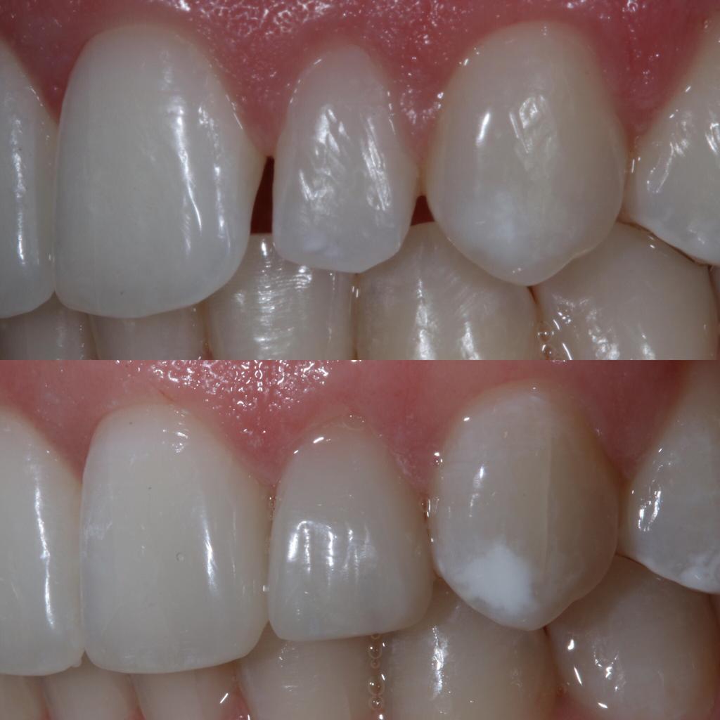 Teeth Bonding Leicester Contouring Leicester Quick Teeth Repair