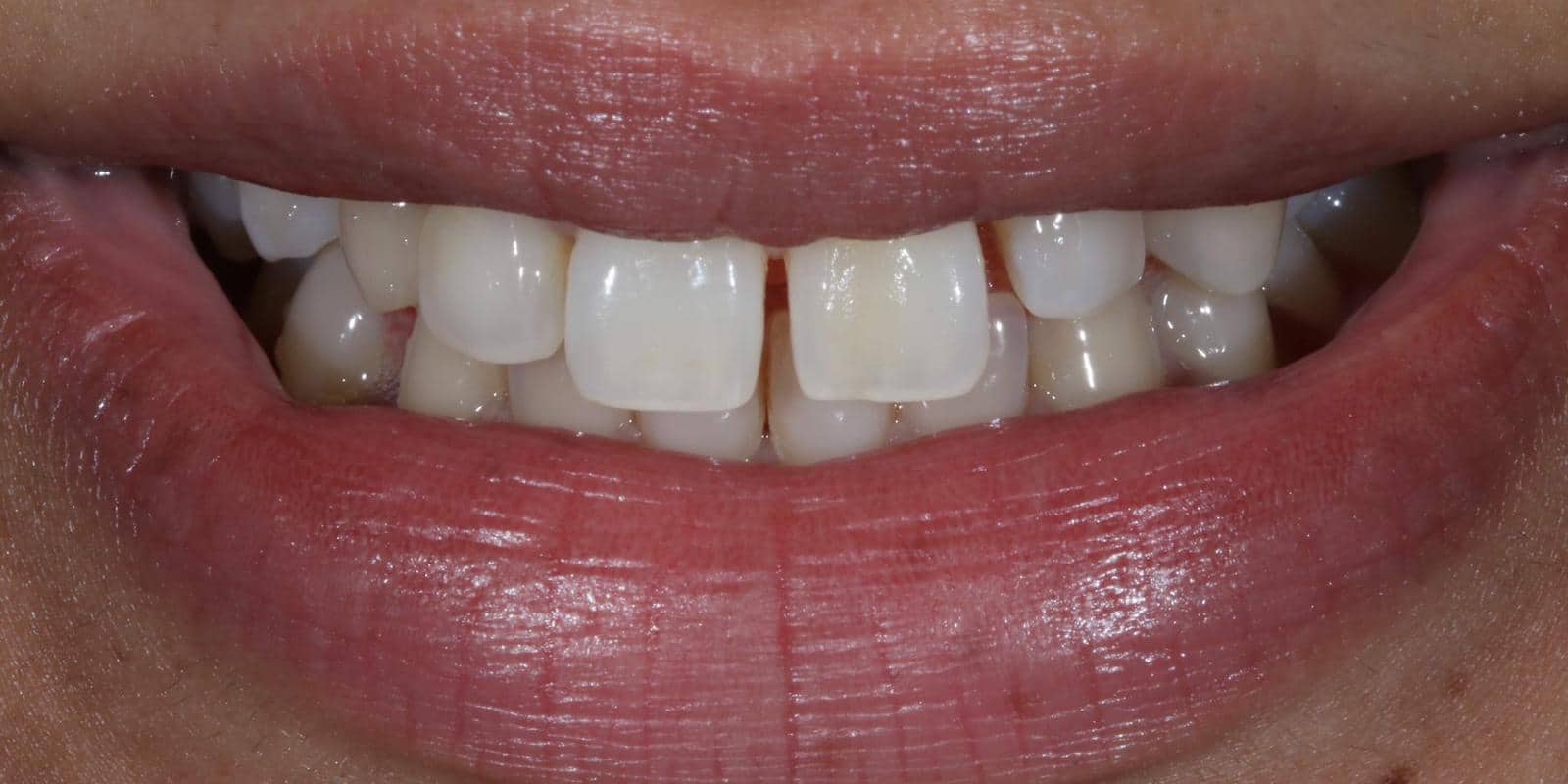 Before & After Cosmetic Oakdale Dental
