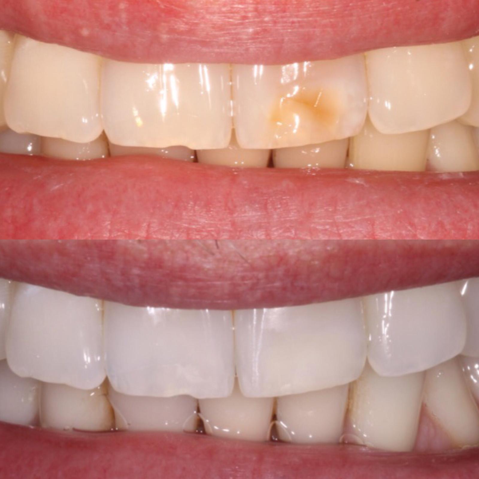 Teeth Bonding Leicester Contouring Leicester Quick Teeth Repair