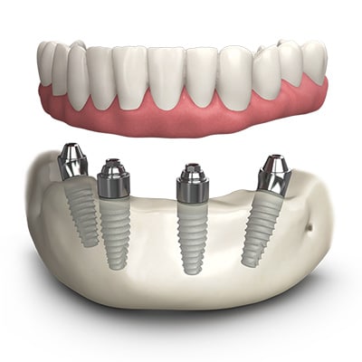 Missing Teeth Dental Implants