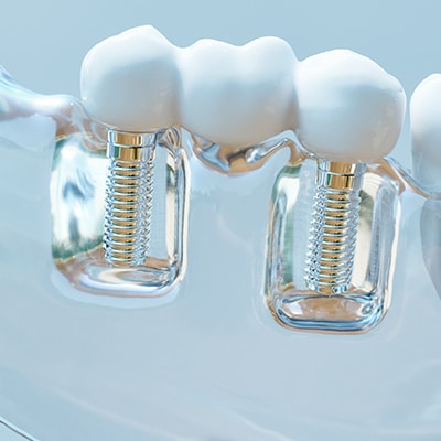 Missing Teeth Dental Implants