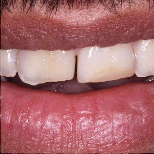 Print Dental Veneers