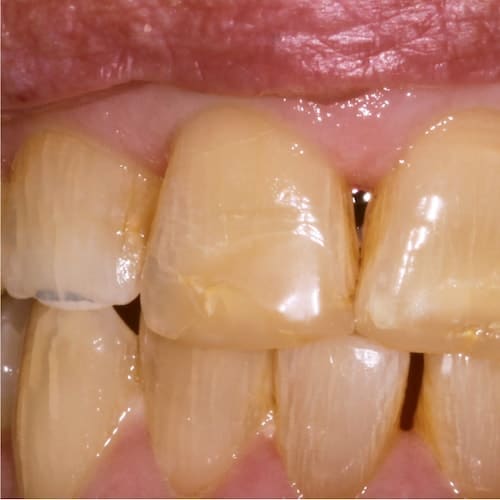 Dental Veneers