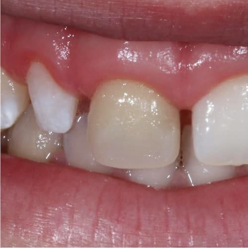 Print Dental Veneers