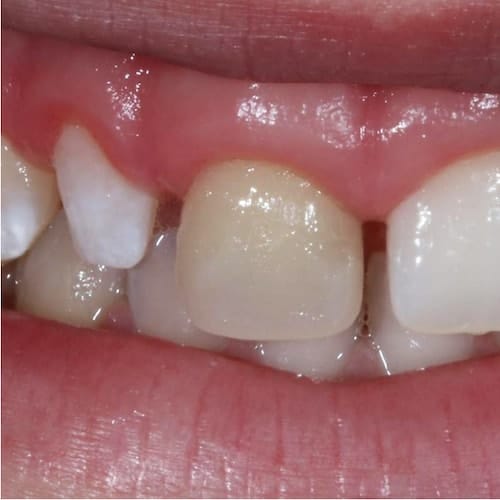 Dental Veneers