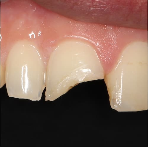 Dental Veneers