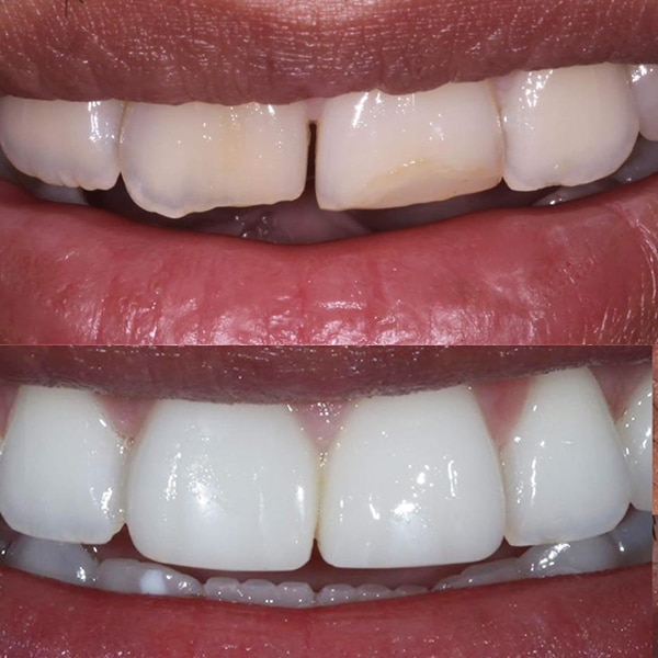 Teeth Bonding Leicester Contouring Leicester Quick Teeth Repair