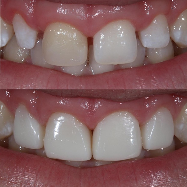 Teeth Bonding Leicester Contouring Leicester Quick Teeth Repair
