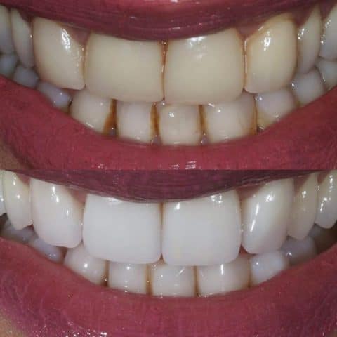 Teeth whitening cost leicester