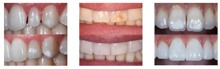 Print Dental Veneers