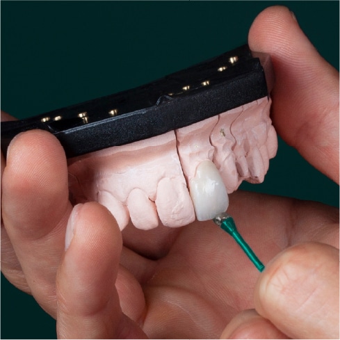 dental-veneers Cosmetic Treatments