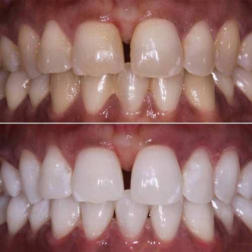 Teeth Whitening