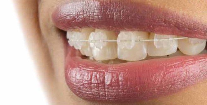 Invisalign Braces