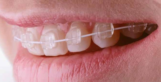 Invisalign Braces