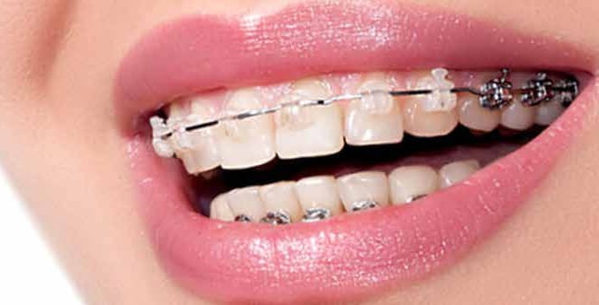 Invisalign Braces