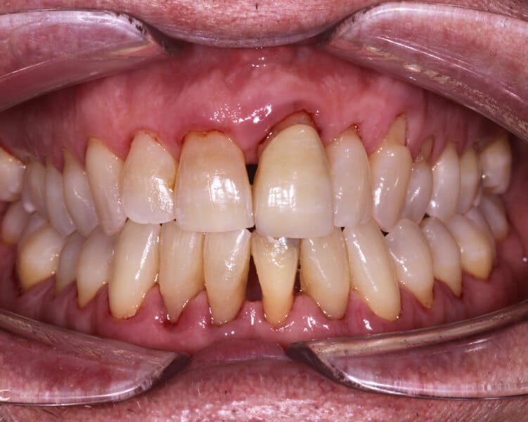 periodititis Hygiene and Airflow
