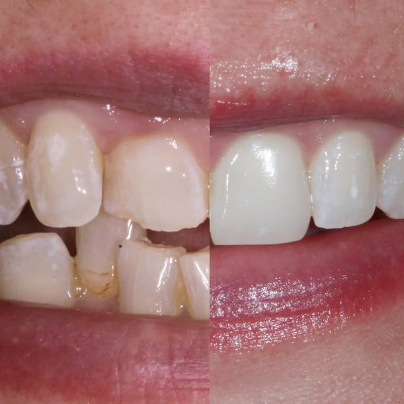 bonding-form-image Cosmetic Treatments