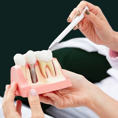 Missing Teeth Dental Implants