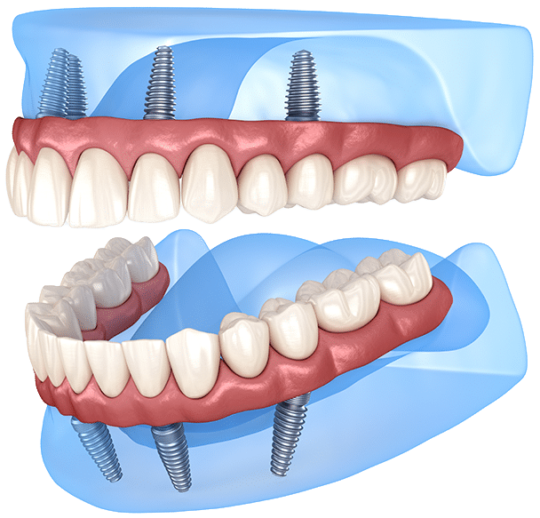 dental-implants-02 The Third Set