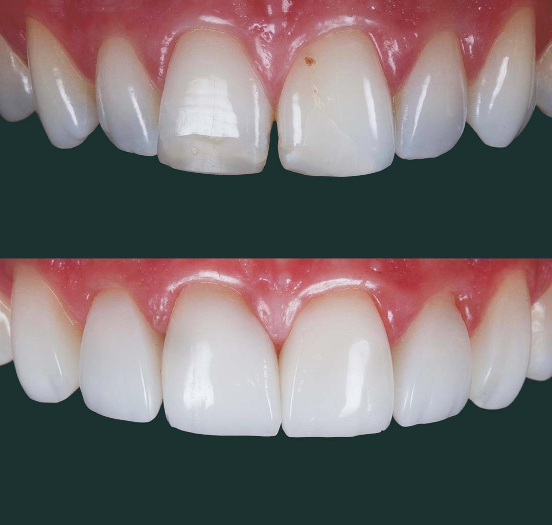 bonding page 2 composite bonding ppc