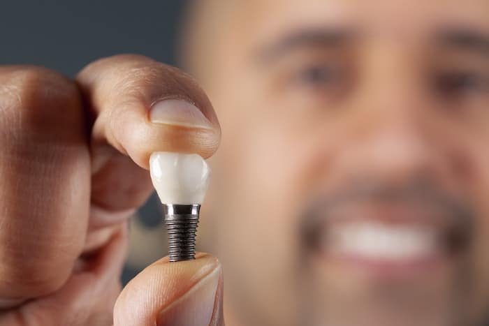 implant Dental Implants Ad 1.1