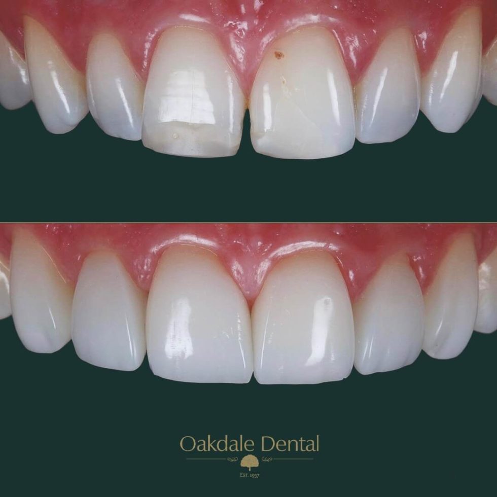 Cosmetic Dentist Leicester Teeth Whitening Dental Veneers Leicester