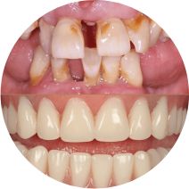 Multiple Tooth Replacement, Leicester