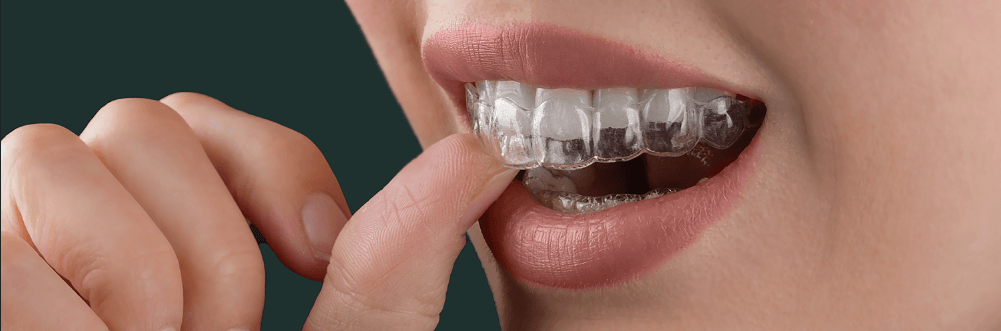 Invisalign Braces