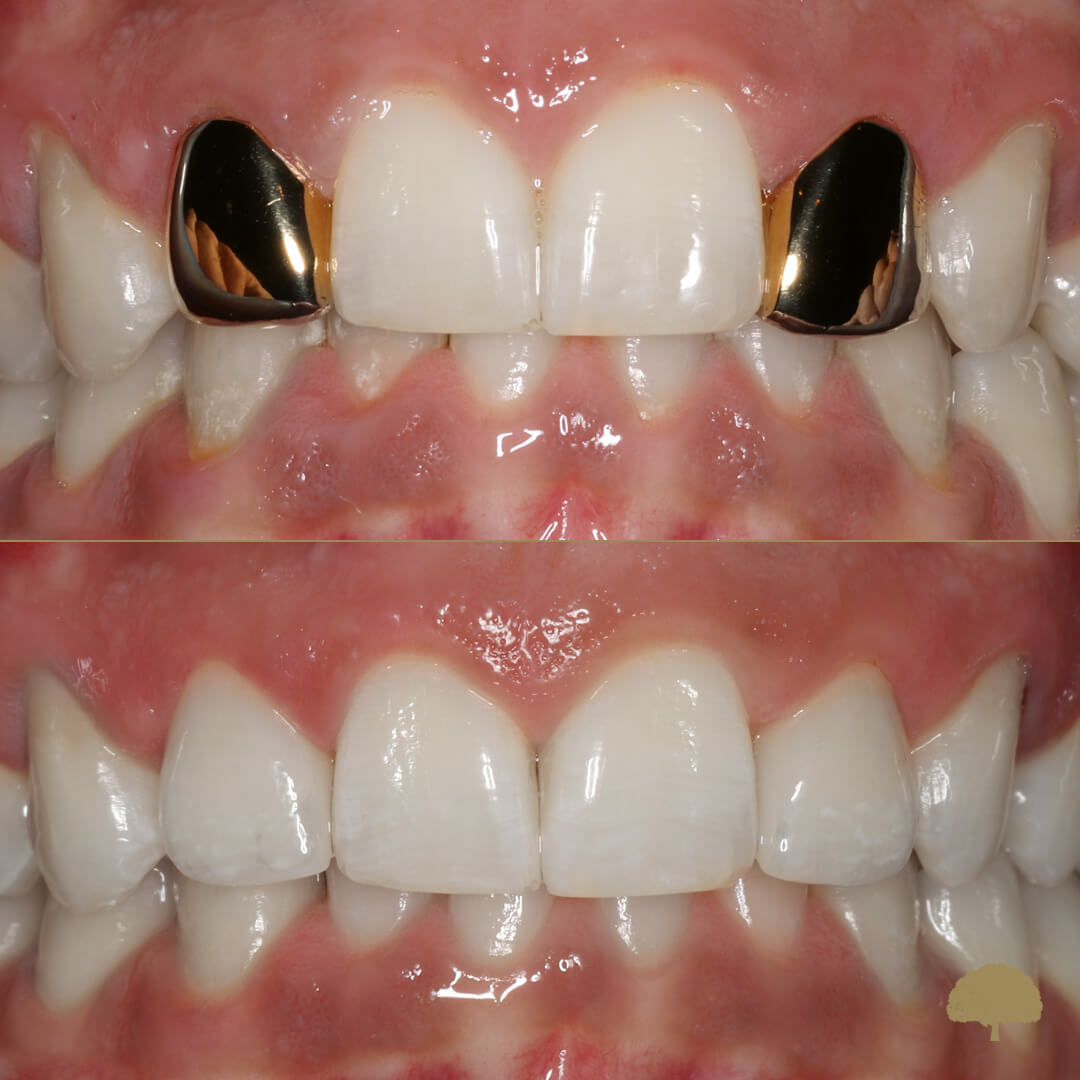 CEREC A Smile In An Hour