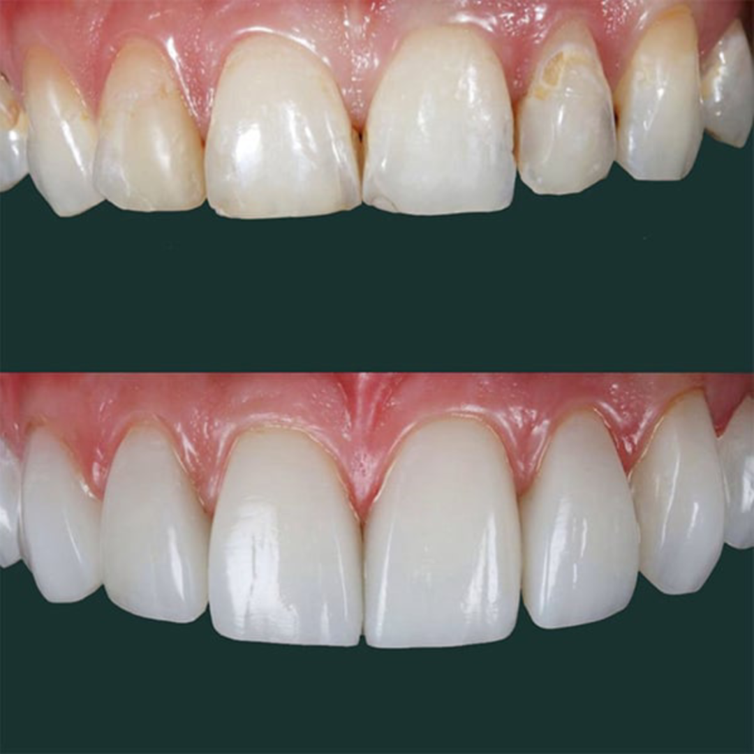 composite bonding