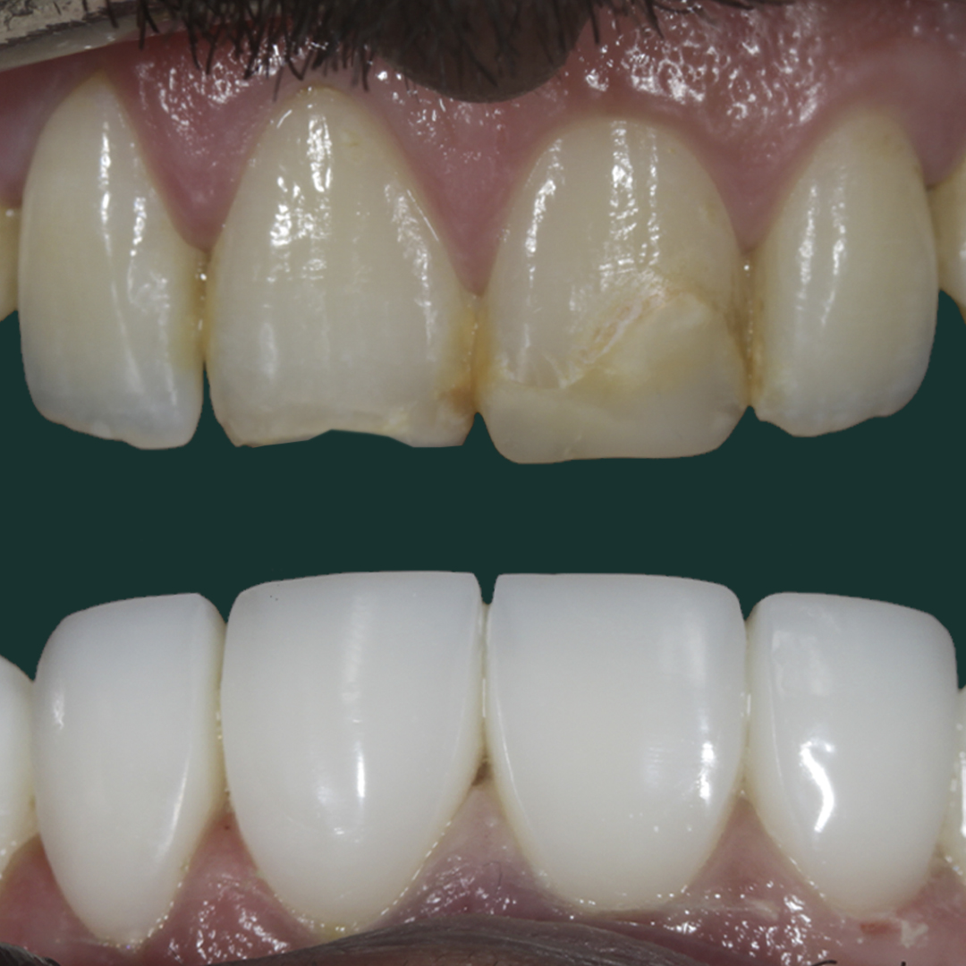 Dental Veneers