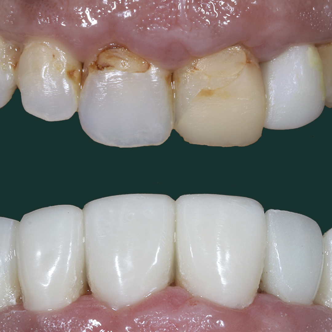 Dental Veneers