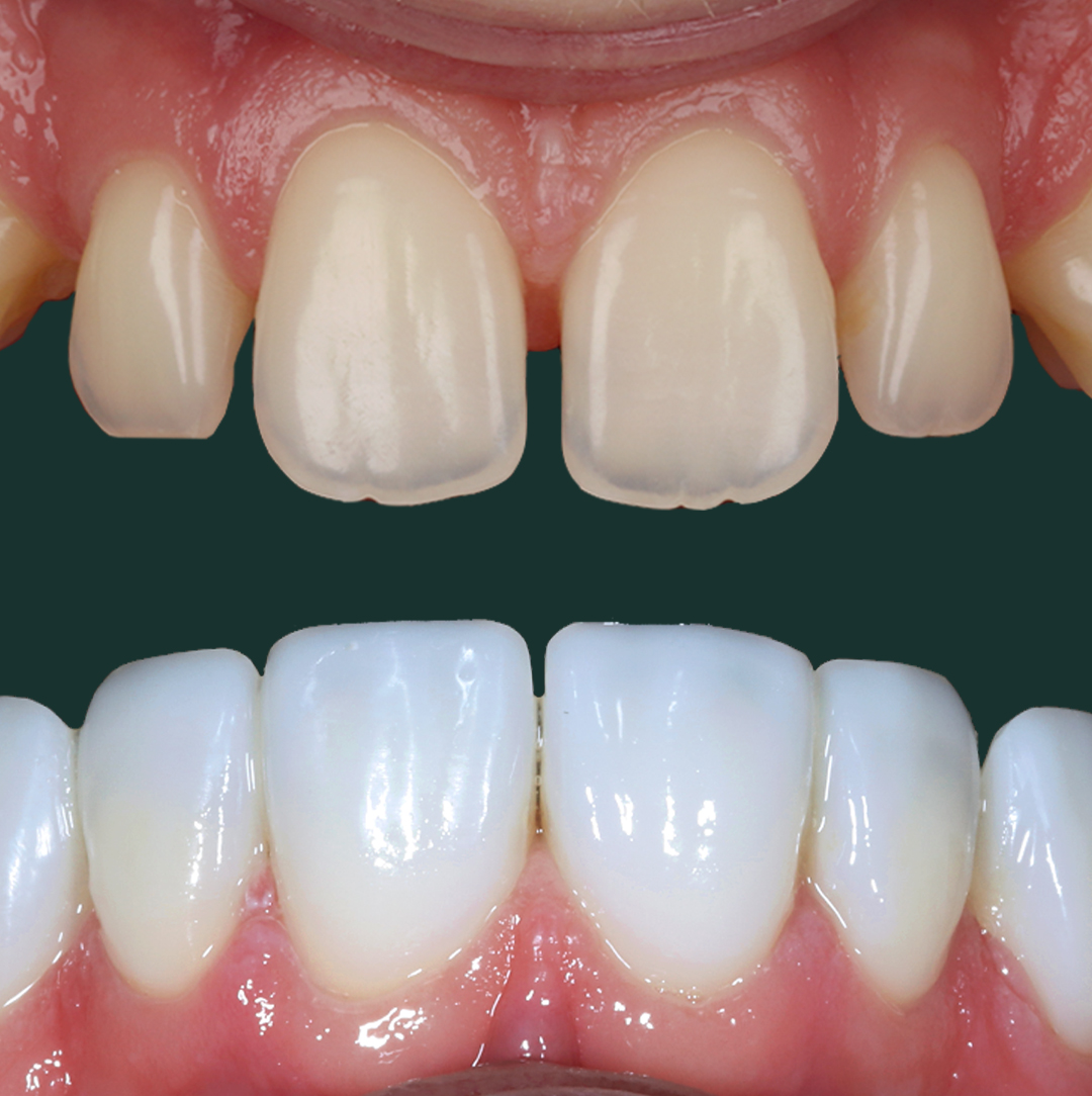 Dental Veneers