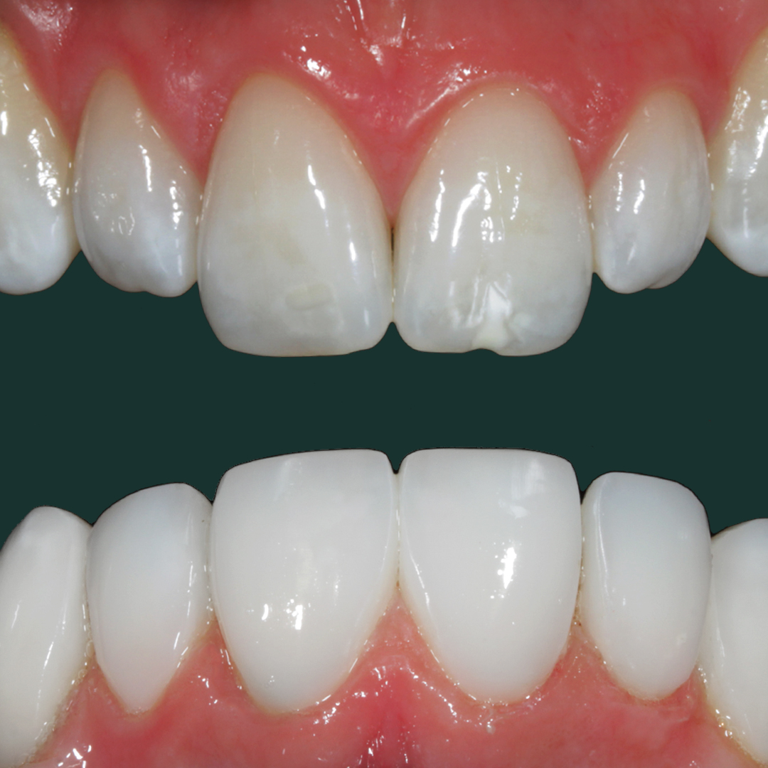 Dental Veneers