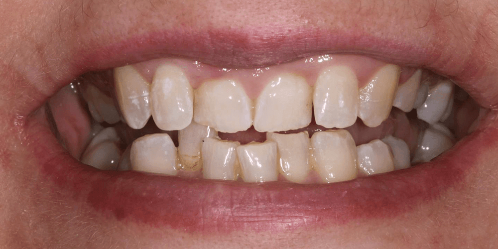 brace 7new