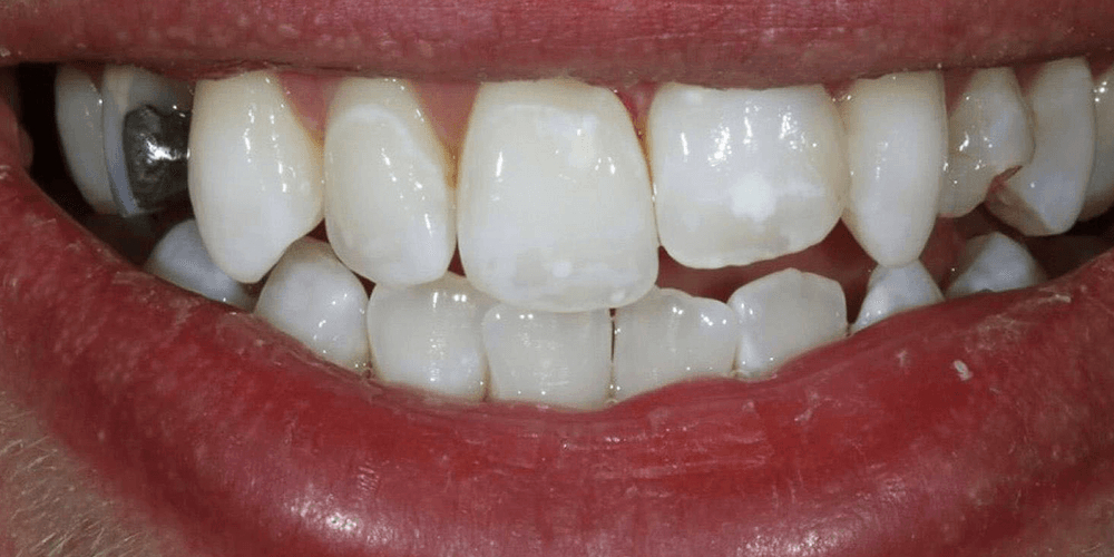 brace new a