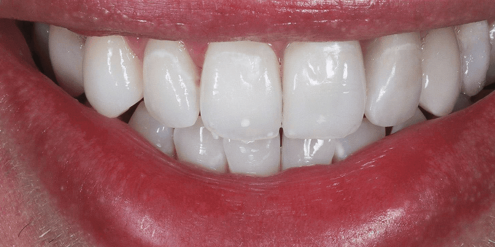 brace new