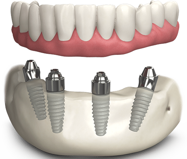 all-on-4-dental-implants-leicester-oakdale-dental