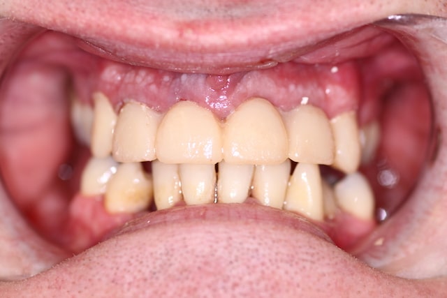 Before and after CEREC missing front teeth treatment in Leicester, Oakdale Dental