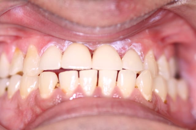 Before and after CEREC treatment in Leicester, Oakdale Dental