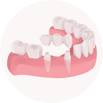 Dental bridge Dental bridge