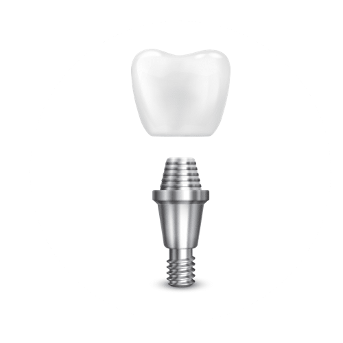 Dental Implant Dental Implant