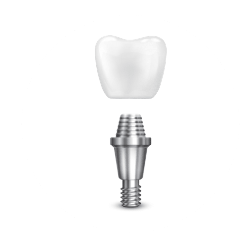 Dental Implant