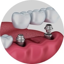 Multiple Tooth Replacement, Leicester