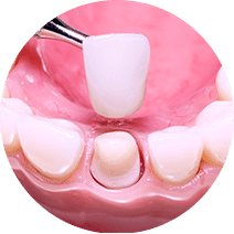 Dental crown Dental crown